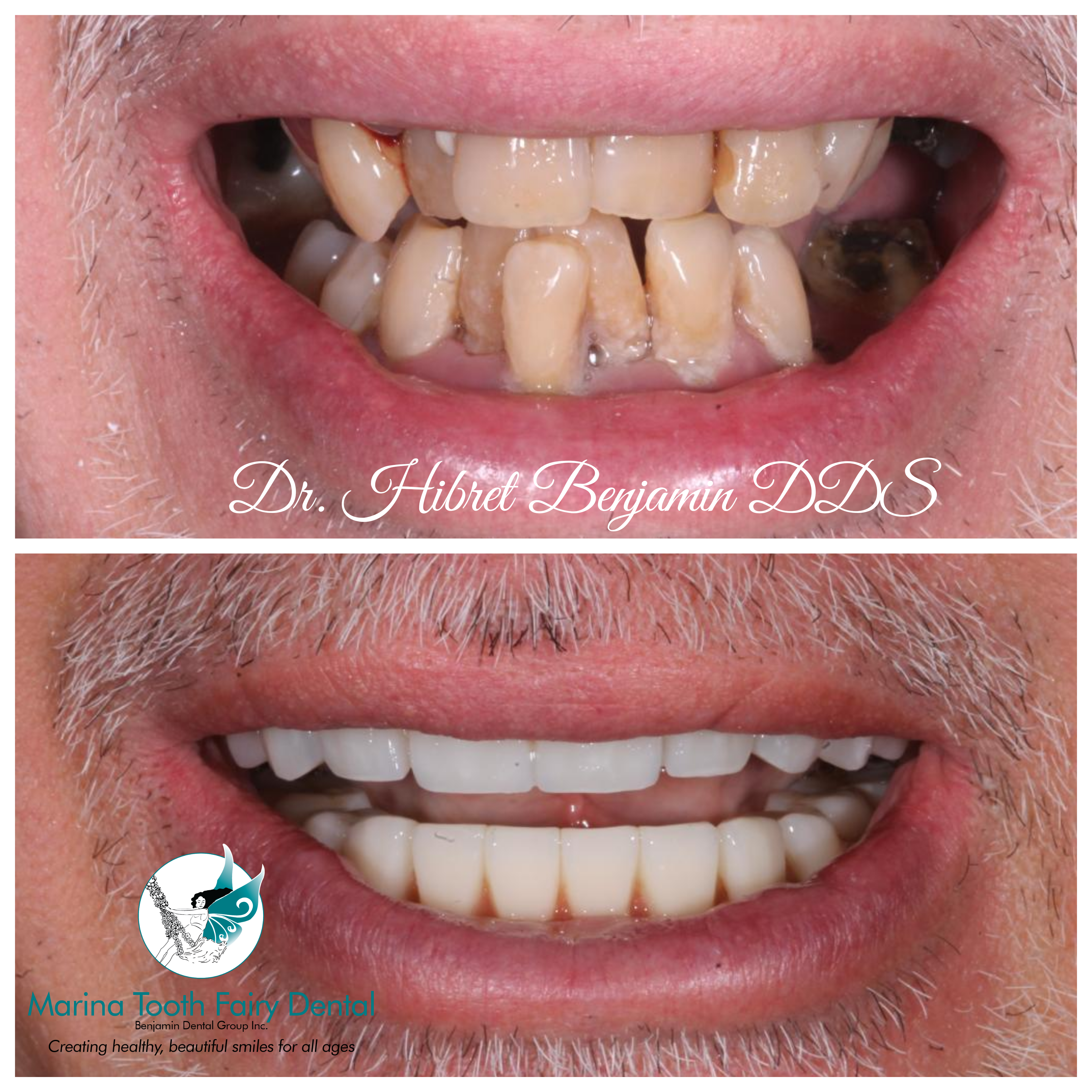 Before and after All-on-4 Dental Implants -1