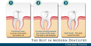 Cracked Tooth Diagram