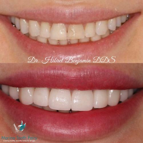 Marina Tooth Fairy Dental Before & After Acid Erosion