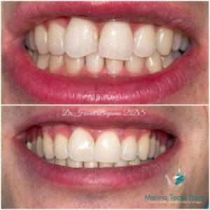 Before & After Series: Cosmetic Makeover - Marina Tooth Fairy Dental