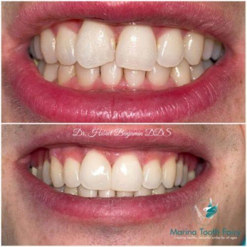 Cosmetic Dentistry Before & After
