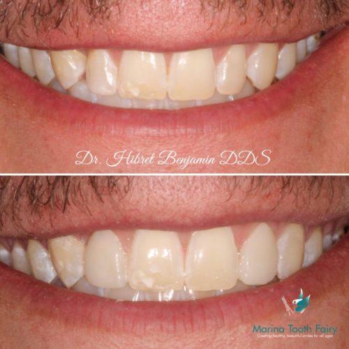 Lateral Veneers Before And After