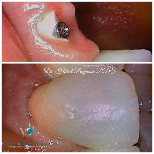 Marina Tooth Fairy Dental Implant Crown 2019